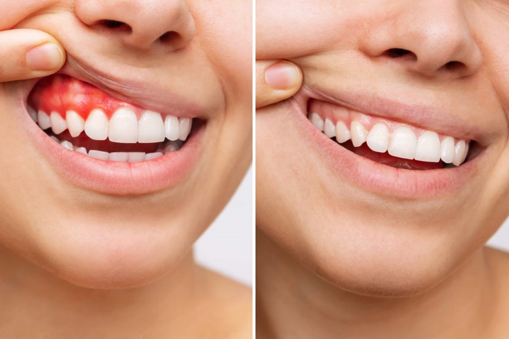 Gum Disease Treatment McKinney TX