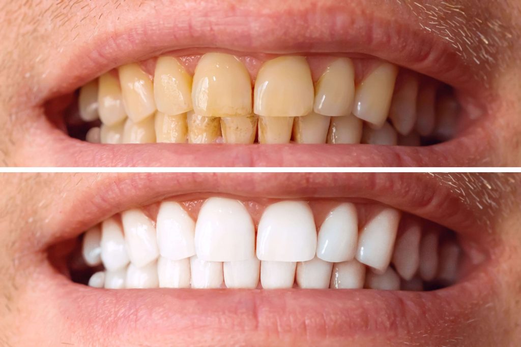Restorative Dentistry in McKinney, TX