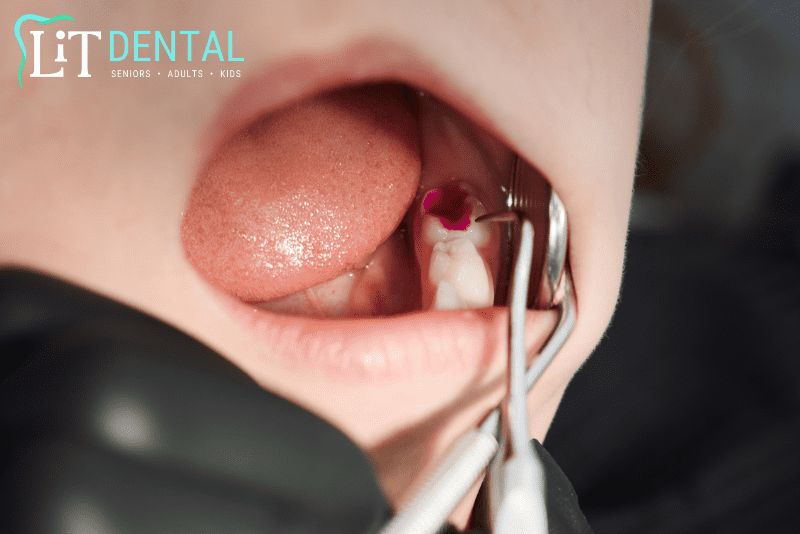 Root Canal