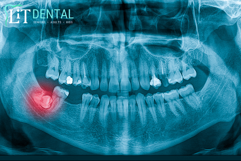 Wisdom Teeth