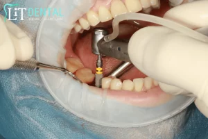 Dental Implants