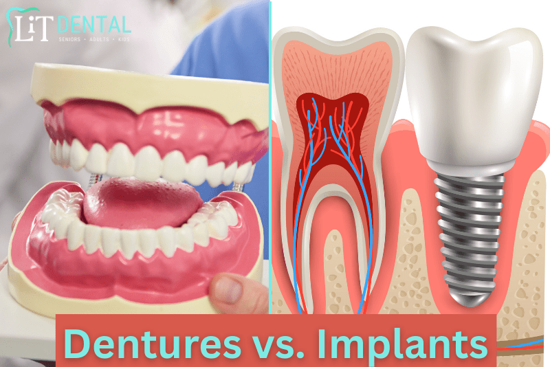 dentures vs. implants
