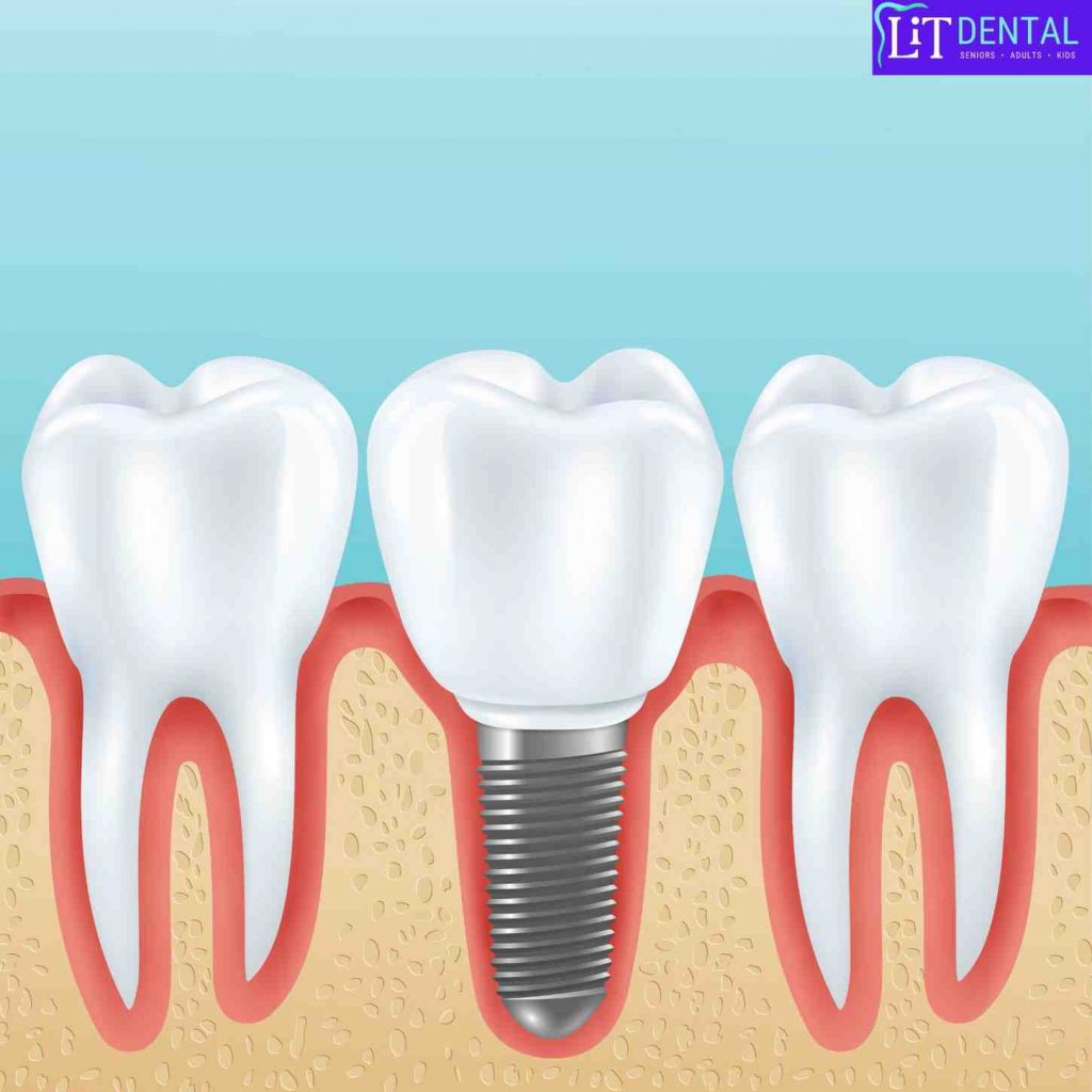 LiT Dental, in Mckinney, TX, provides affordable Dental Crowns Treatment