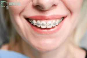 How much do braces cost