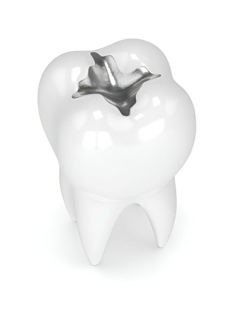 Cost caomparison of tooth filling materials
