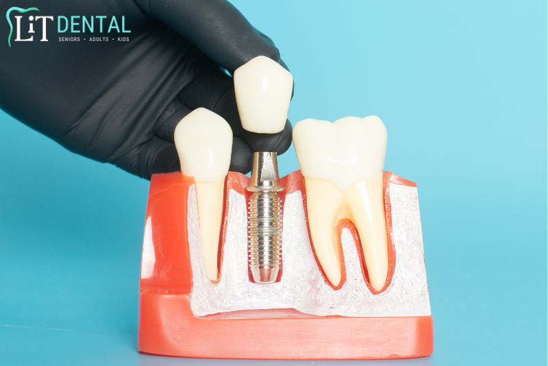 dental implants