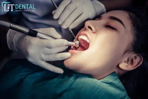 root canal