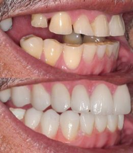 A Sachse patient got restored their missing molars with a dental implant and CEREC crown at LiT Dental