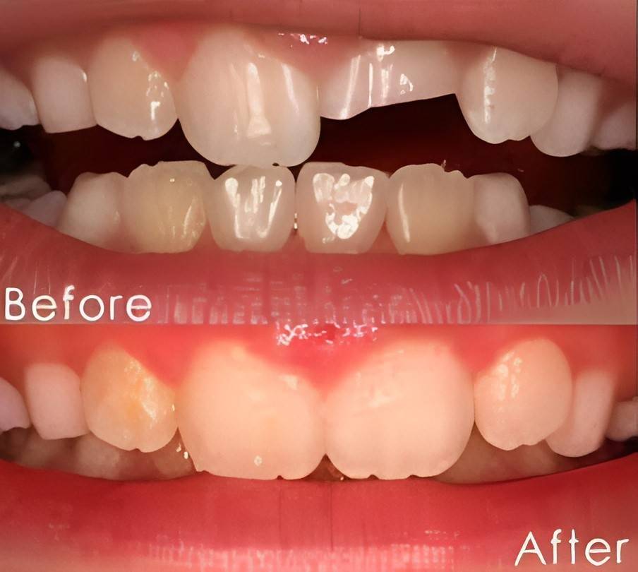 Patient had a cracked central incisor treated with Cracked Tooth Repair at LiT Dental Clinic