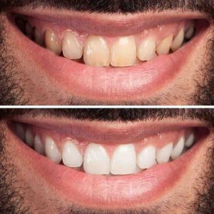 Princeton patient showing before and after results of professional teeth whitening at LiT Dental
