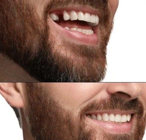 before and after shot of dental implant + crown treatment