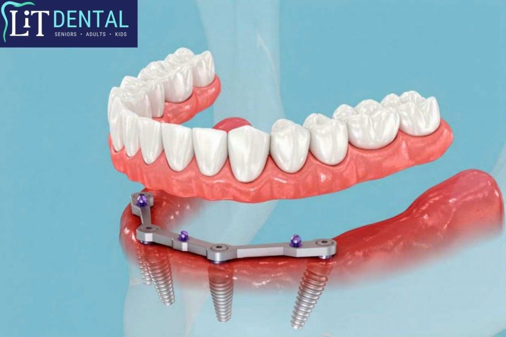 Patients in McKinney can get implant-supported dentures to at LiT Dental CLinic