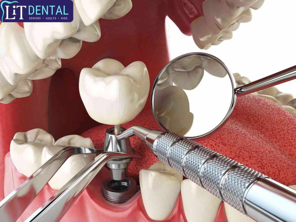 Dental Implant Procedure Comfortably Performed at LiT Dental