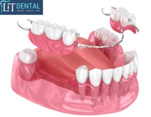 Uninsured patients can get affordable Partial dentures LiT Dental Clinic