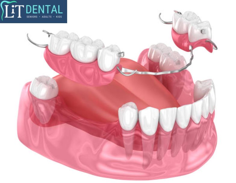 Uninsured patients can get affordable Partial dentures LiT Dental Clinic