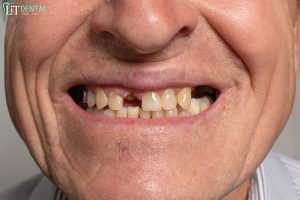 Can Rotten Teeth Be Fixed