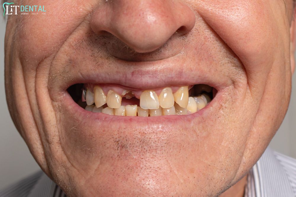 Can Rotten Teeth Be Fixed
