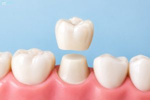 What Is a Dental Crown
