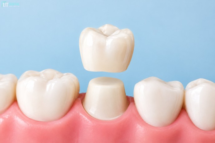 What Is a Dental Crown